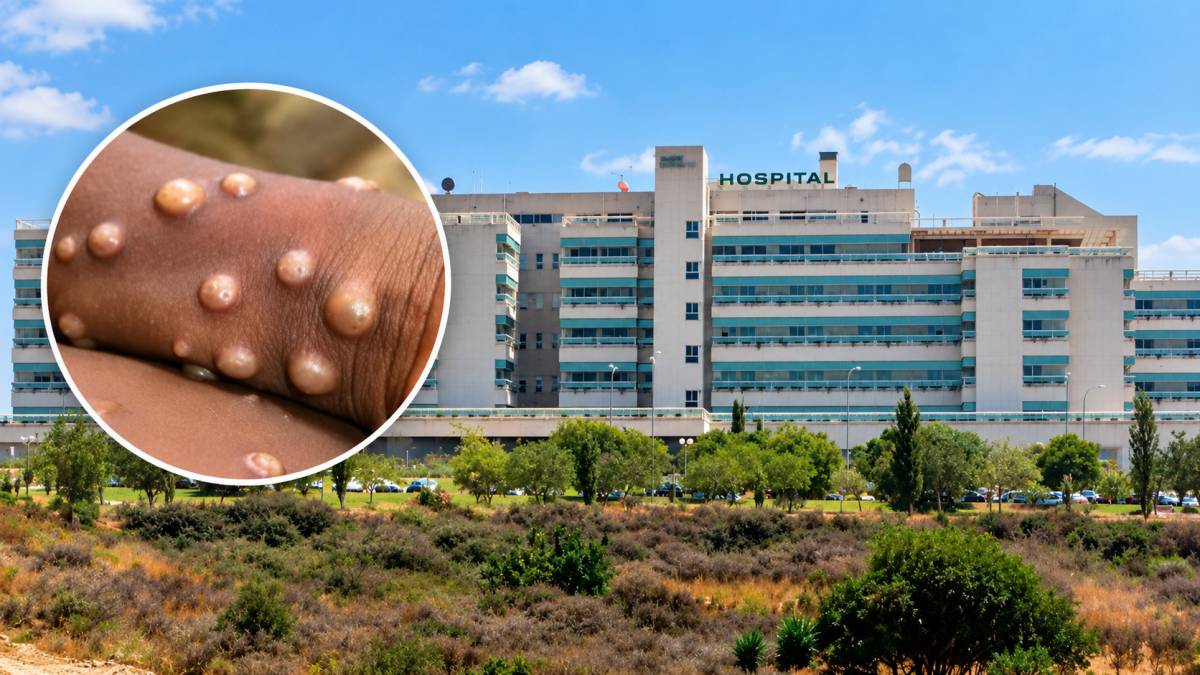 La viruela del mono expande su mapa contagioso en España y ya alcanza Andalucía: un ingresado en Marbella