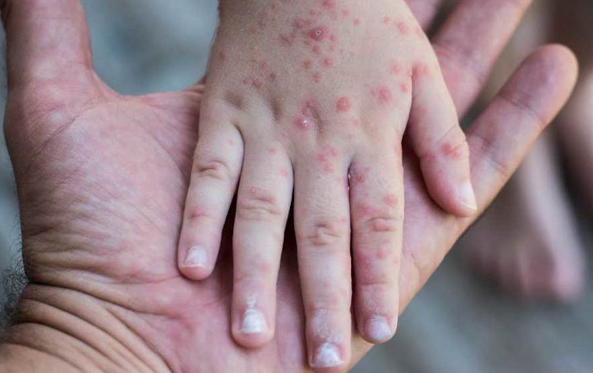 La OMS confirma brotes activos de viruela del mono en 46 países y alerta del riesgo de transmisión comunitaria.
