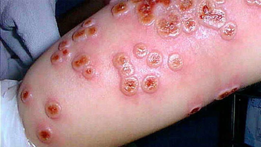 Brazo afectado por la viruela del mono. Brazo afectado por la viruela del mono.