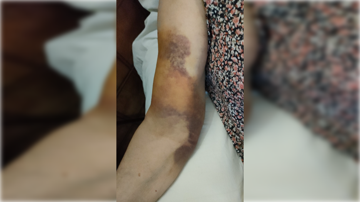 Así amaneció el brazo de la mujer de 91 años que ha sido diagnosticada por teléfono.