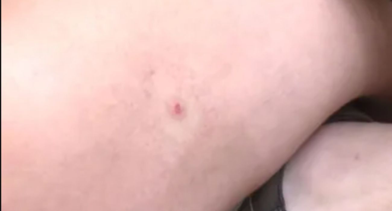 El pinchazo sufrido por una joven víctima de agresión por sumisión química. El pinchazo sufrido por una joven víctima de agresión por sumisión química.