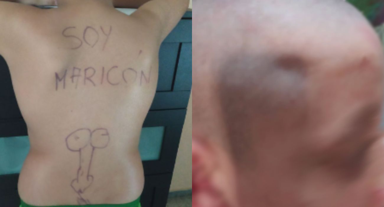 Los insultos grabados en el cuerpo y la agresión en el cráneo que ha sufrido este niño de 13 años. Los insultos grabados en el cuerpo y la agresión en el cráneo que ha sufrido este niño de 13 años.