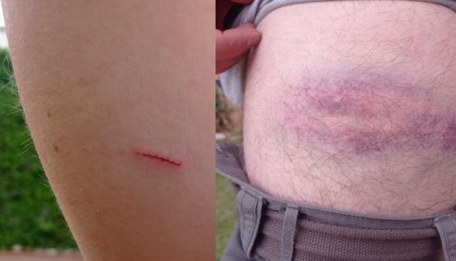 Heridas y moratones sufridas por Juanma.