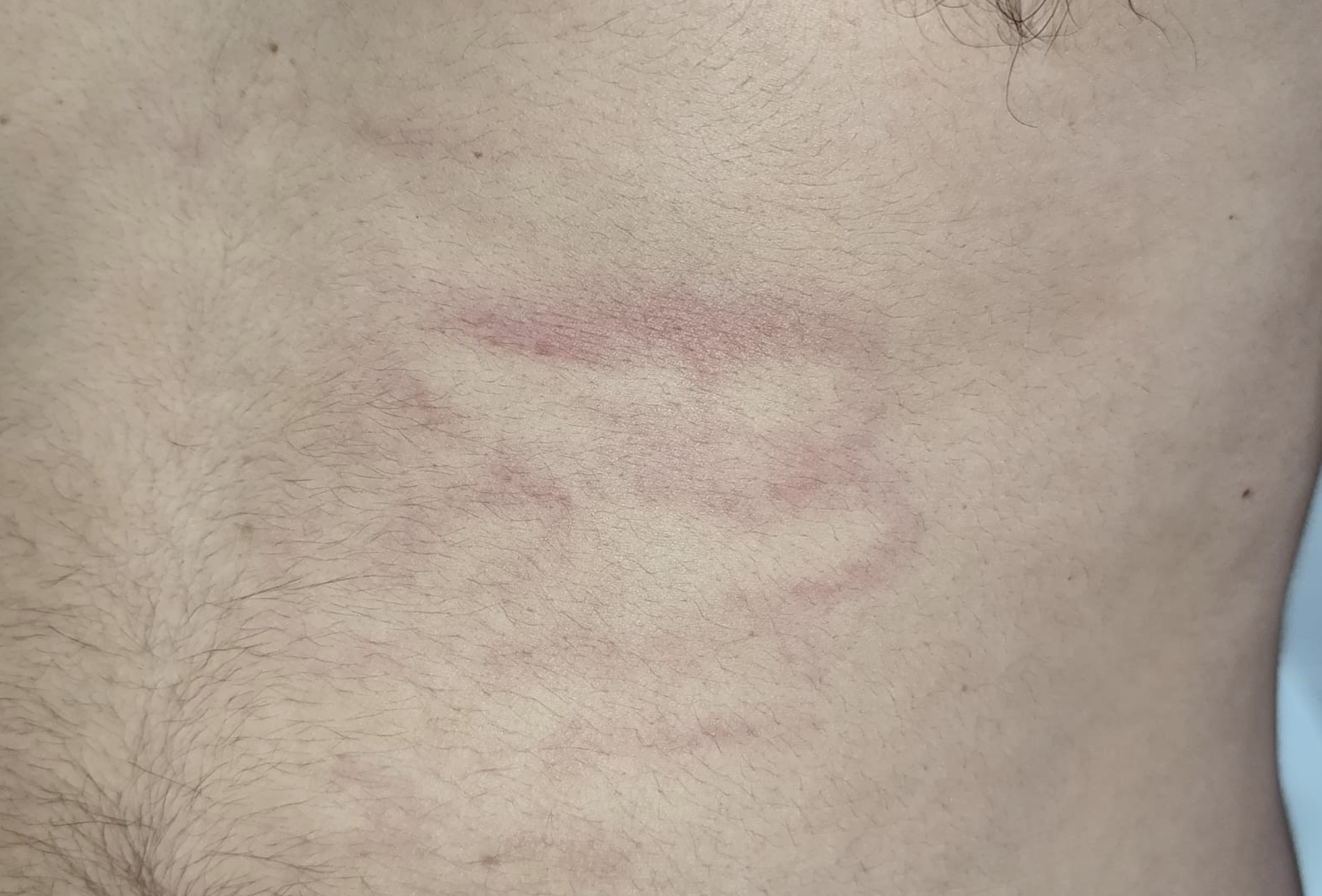 Señales en el cuerpo del árbitro Yeray Morales tras la agresión sufrida. Señales en el cuerpo del árbitro Yeray Morales tras la agresión sufrida.