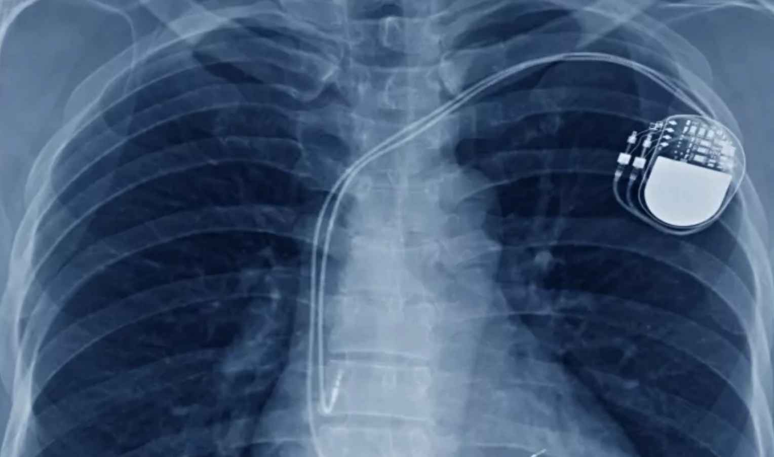El desfibrilador automático implantable que necesita el joven de 16 años.